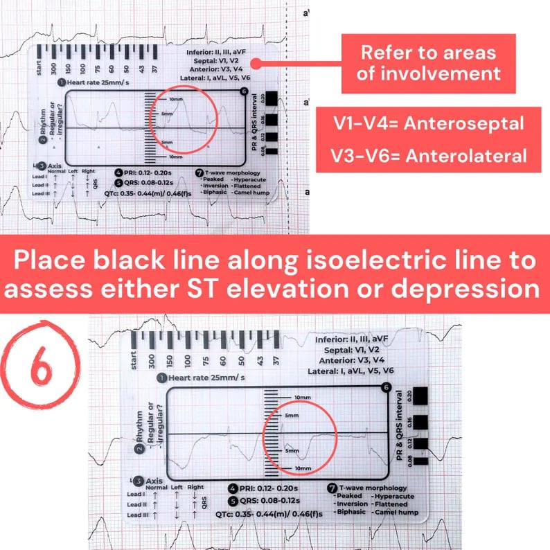 🔥LAST DAY 50% OFF - 🎁ECG 7 Step Ruler