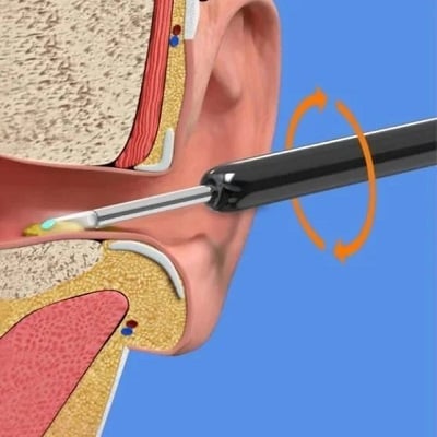 🎁Hot Sale 49% OFF🎁-Clean Earwax - WiFi Visible Wax Elimination Spoon,USB 1080P HD Load Otoscope